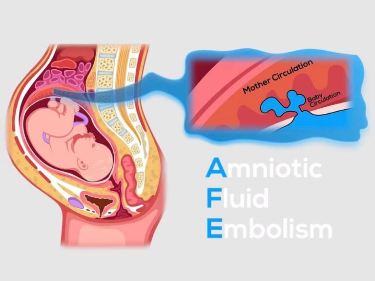 Amniotic Fluid Embolism